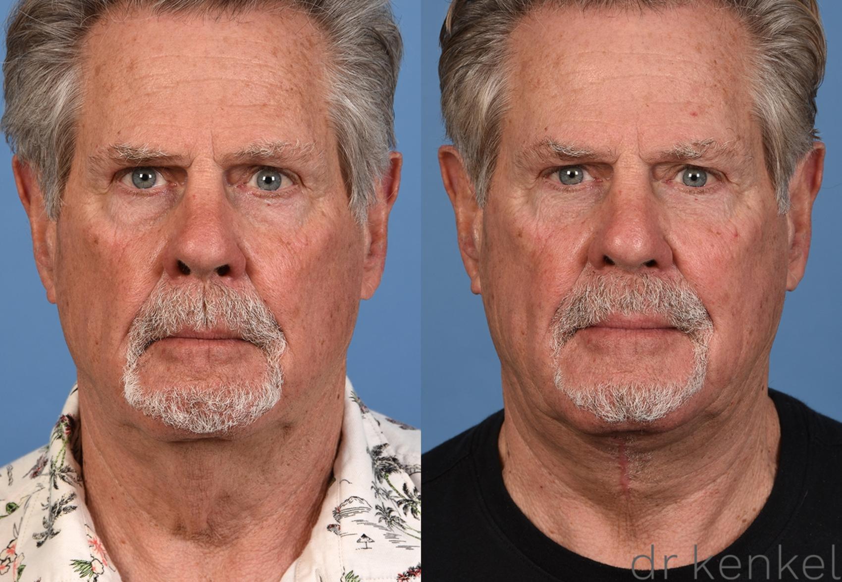 Before & After Direct Neck Excision Case 353 Front View in Dallas, Frisco, McKinney, Prosper, Allen, Celina, Denton, Anna, TX