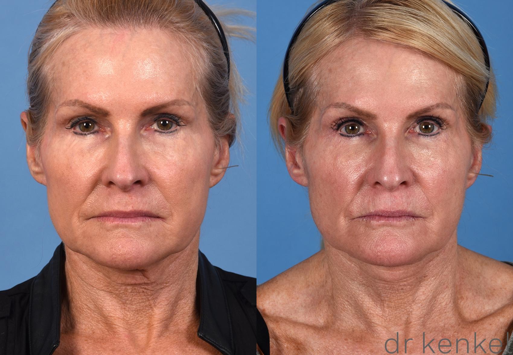 Before & After Eyelid Surgery Case 354 Front View in Dallas, Frisco, McKinney, Prosper, Allen, Celina, Denton, Anna, TX
