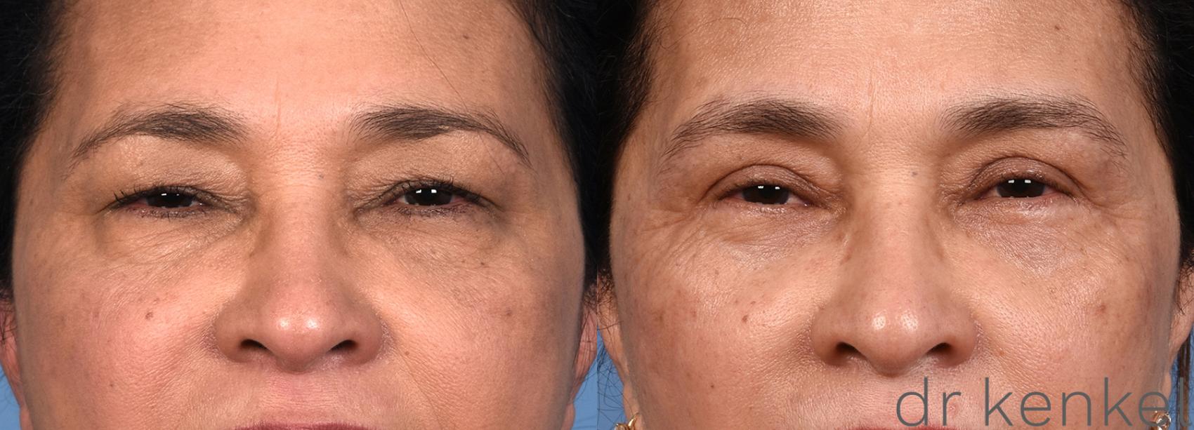 Before & After Eyelid Surgery Case 359 Front View in Dallas, Frisco, McKinney, Prosper, Allen, Celina, Denton, Anna, TX