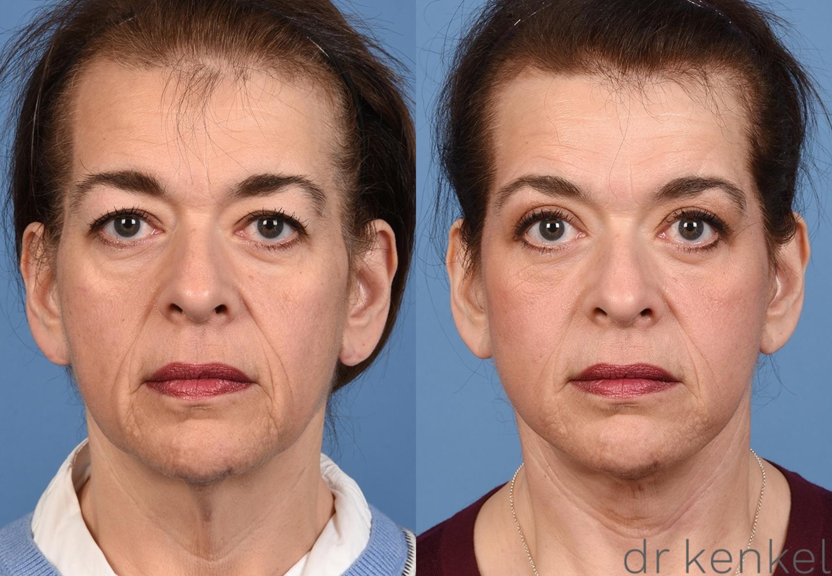 Before & After Eyelid Surgery Case 365 Front View in Dallas, Frisco, McKinney, Prosper, Allen, Celina, Denton, Anna, TX