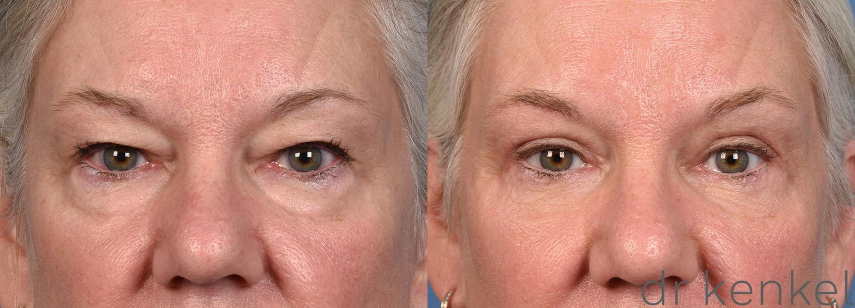 Before & After Eyelid Surgery Case 366 Front View in Dallas, Frisco, McKinney, Prosper, Allen, Celina, Denton, Anna, TX