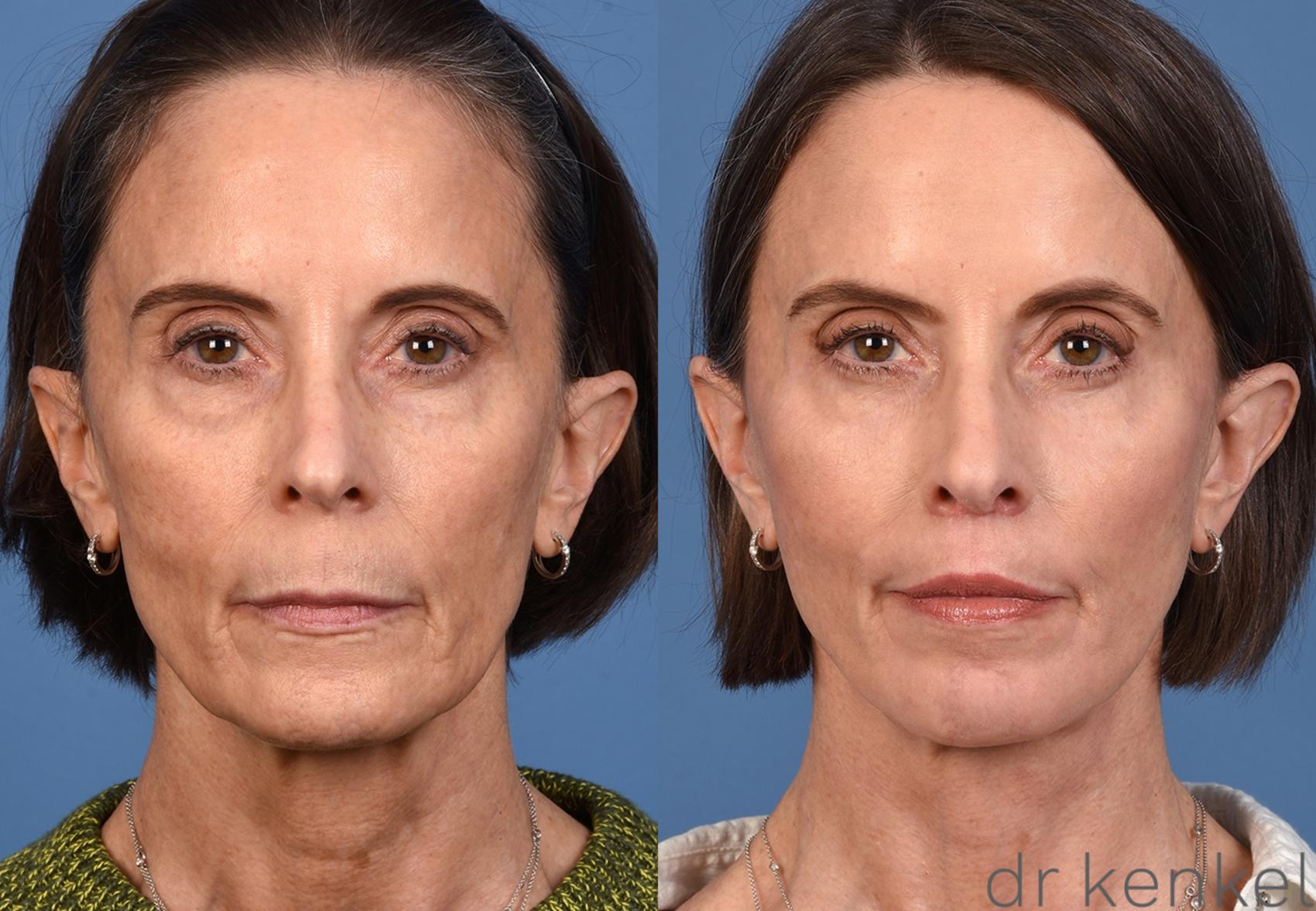 Before & After Facial Rejuvenation Case 368 Front View in Dallas, Frisco, McKinney, Prosper, Allen, Celina, Denton, Anna, TX