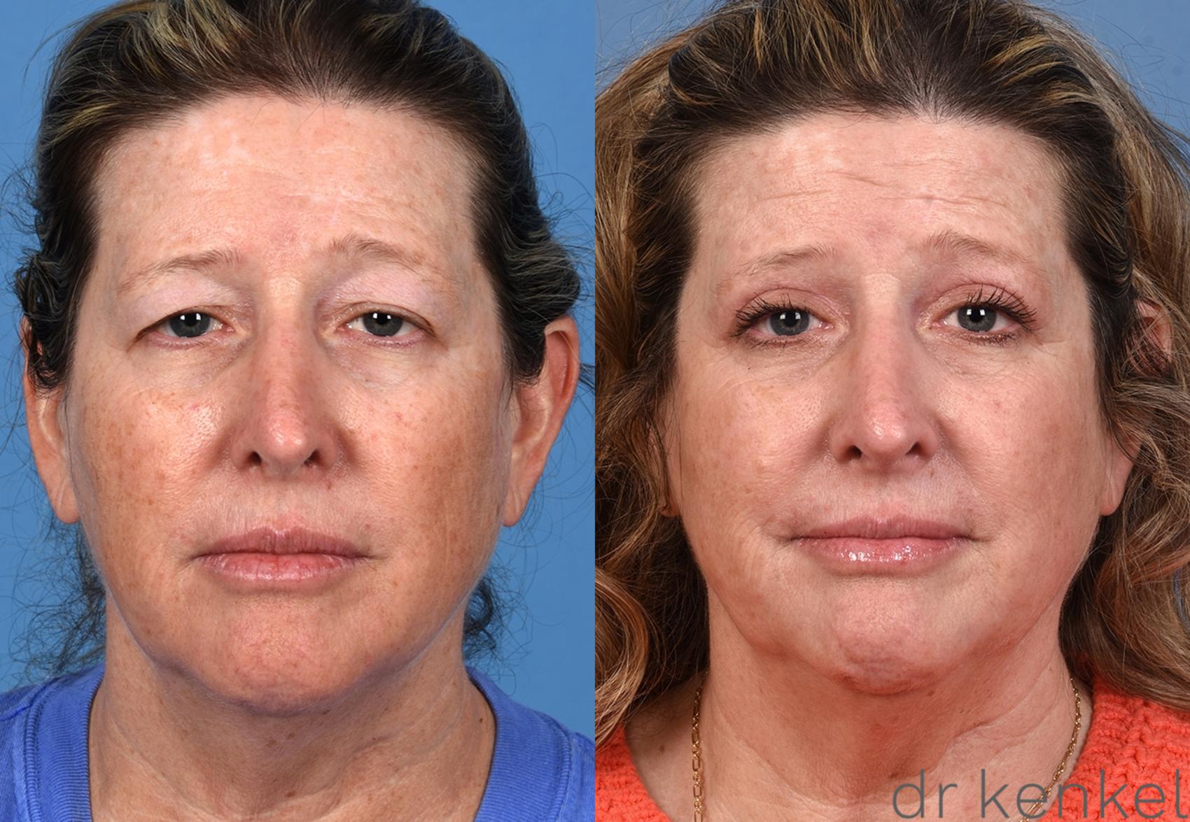 Before & After Eyelid Surgery Case 374 Front View in Dallas, Frisco, McKinney, Prosper, Allen, Celina, Denton, Anna, TX