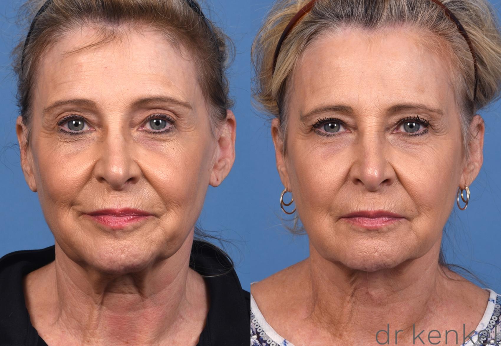 Before & After Eyelid Surgery Case 378 Front View in Dallas, Frisco, McKinney, Prosper, Allen, Celina, Denton, Anna, TX