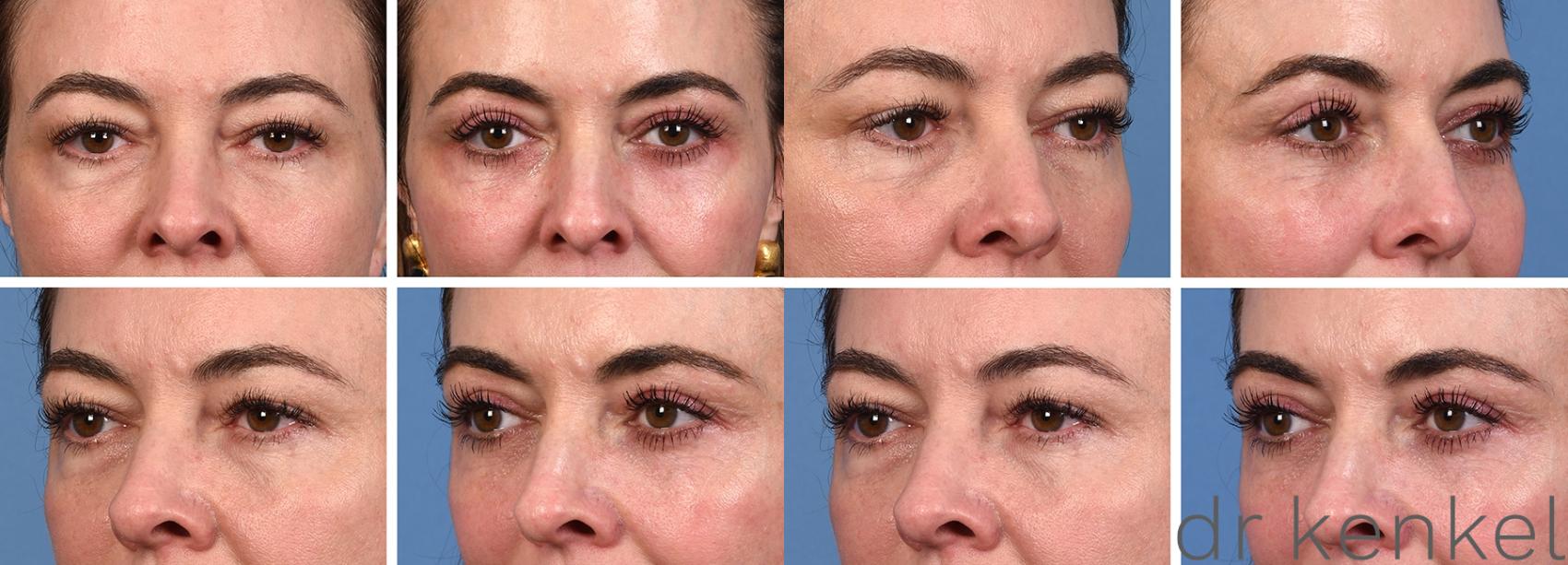 Before & After Eyelid Surgery Case 379 Front/Side View in Dallas, Frisco, McKinney, Prosper, Allen, Celina, Denton, Anna, TX