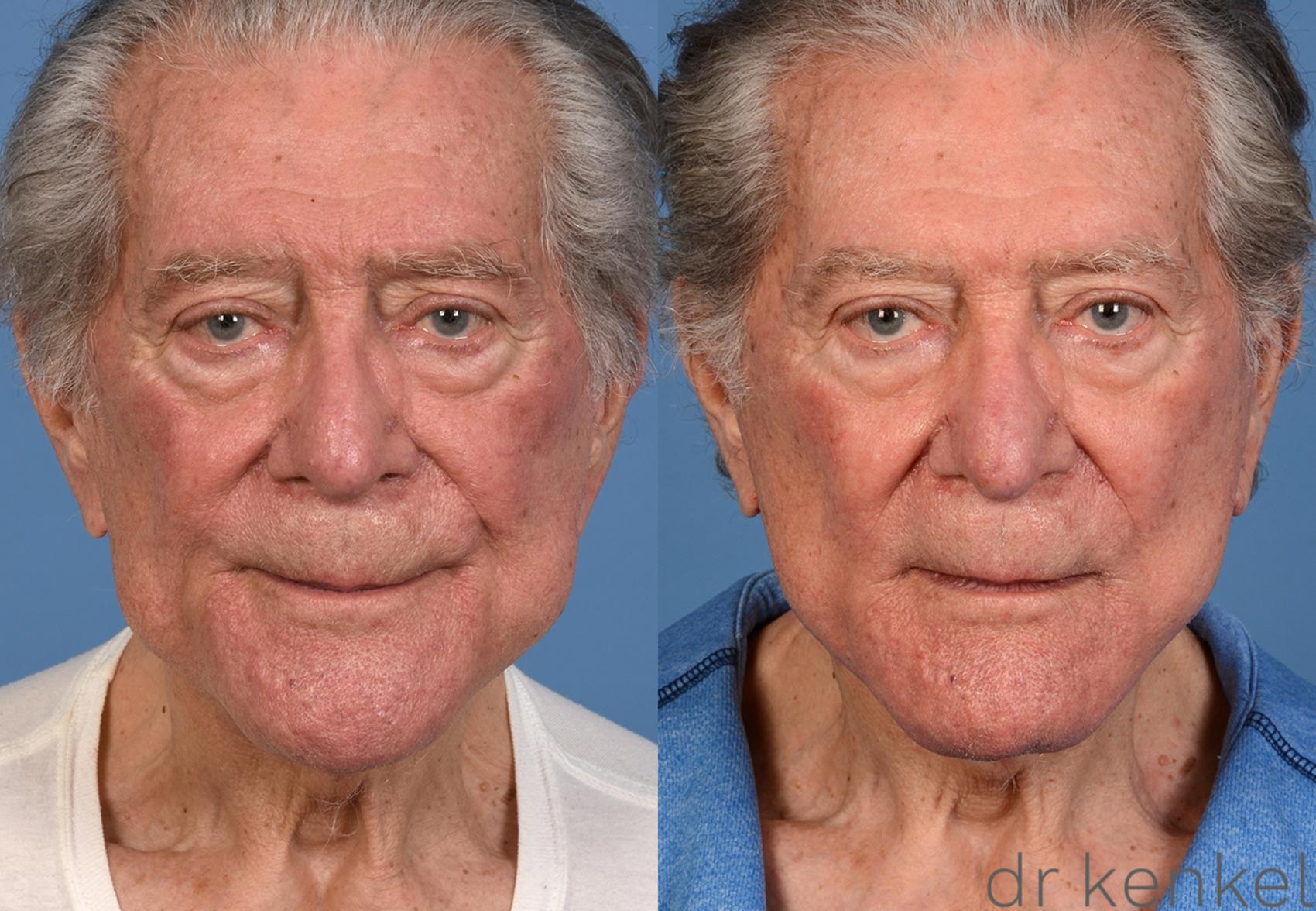 Before & After Facelift Case 356 Front View in Dallas, Frisco, McKinney, Prosper, Allen, Celina, Denton, Anna, TX