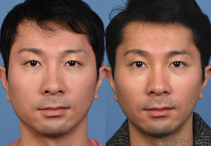 Before & After Nonsurgical for Men Case 377 Front View in Dallas, Frisco, McKinney, Prosper, Allen, Celina, Denton, Anna, TX