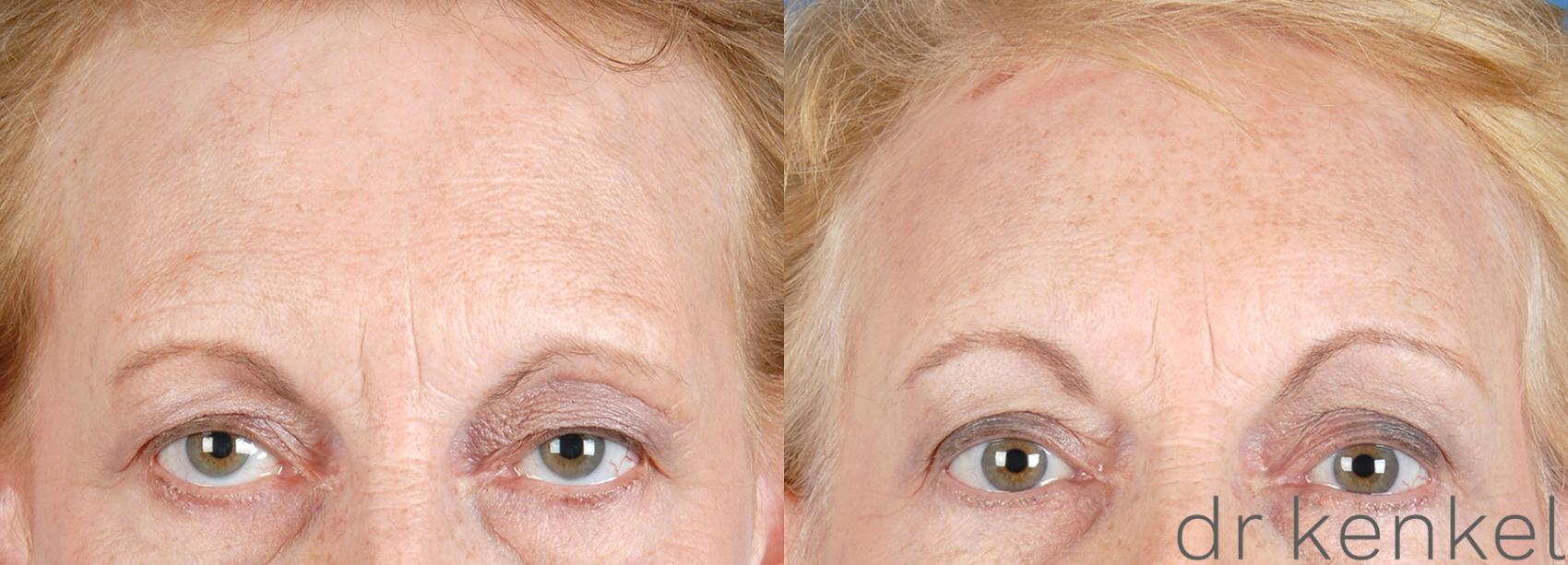 Before & After Brow Lift Case 185 View #1 View in Dallas, TX