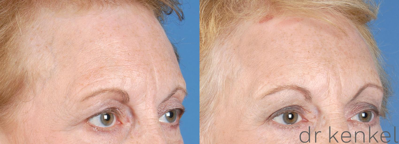 Before & After Brow Lift Case 185 View #2 View in Dallas, TX