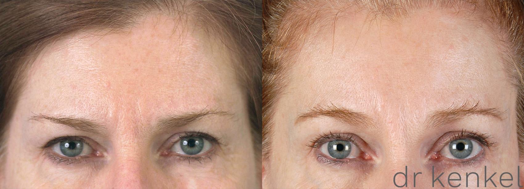 Before & After Brow Lift Case 186 View #1 View in Dallas, TX