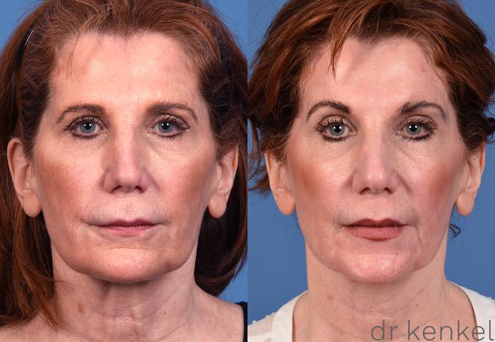 Before & After Skin Care Case 350 Left Side View in Dallas, Frisco, McKinney, Prosper, Allen, Celina, Denton, Anna, TX
