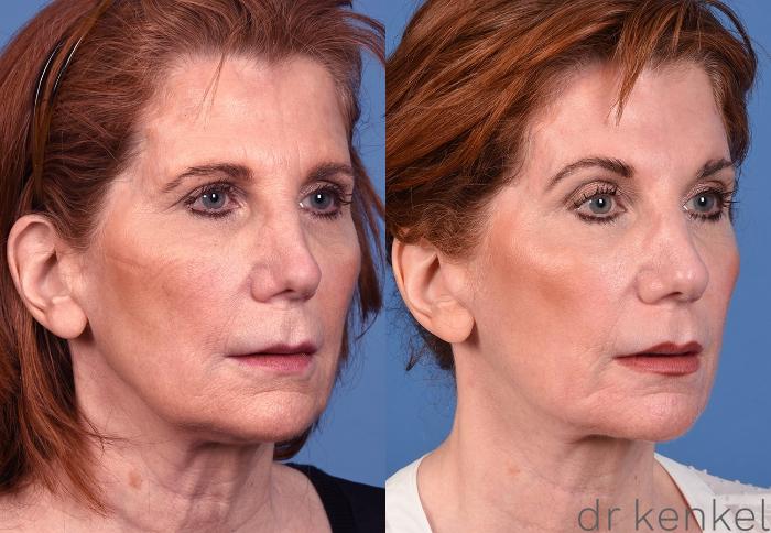 Before & After Skin Care Case 350 Right Oblique View in Dallas, Frisco, McKinney, Prosper, Allen, Celina, Denton, Anna, TX