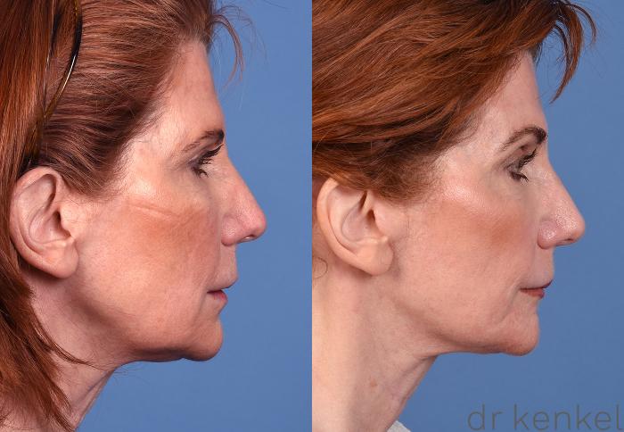 Before & After Skin Care Case 350 Right Side View in Dallas, Frisco, McKinney, Prosper, Allen, Celina, Denton, Anna, TX