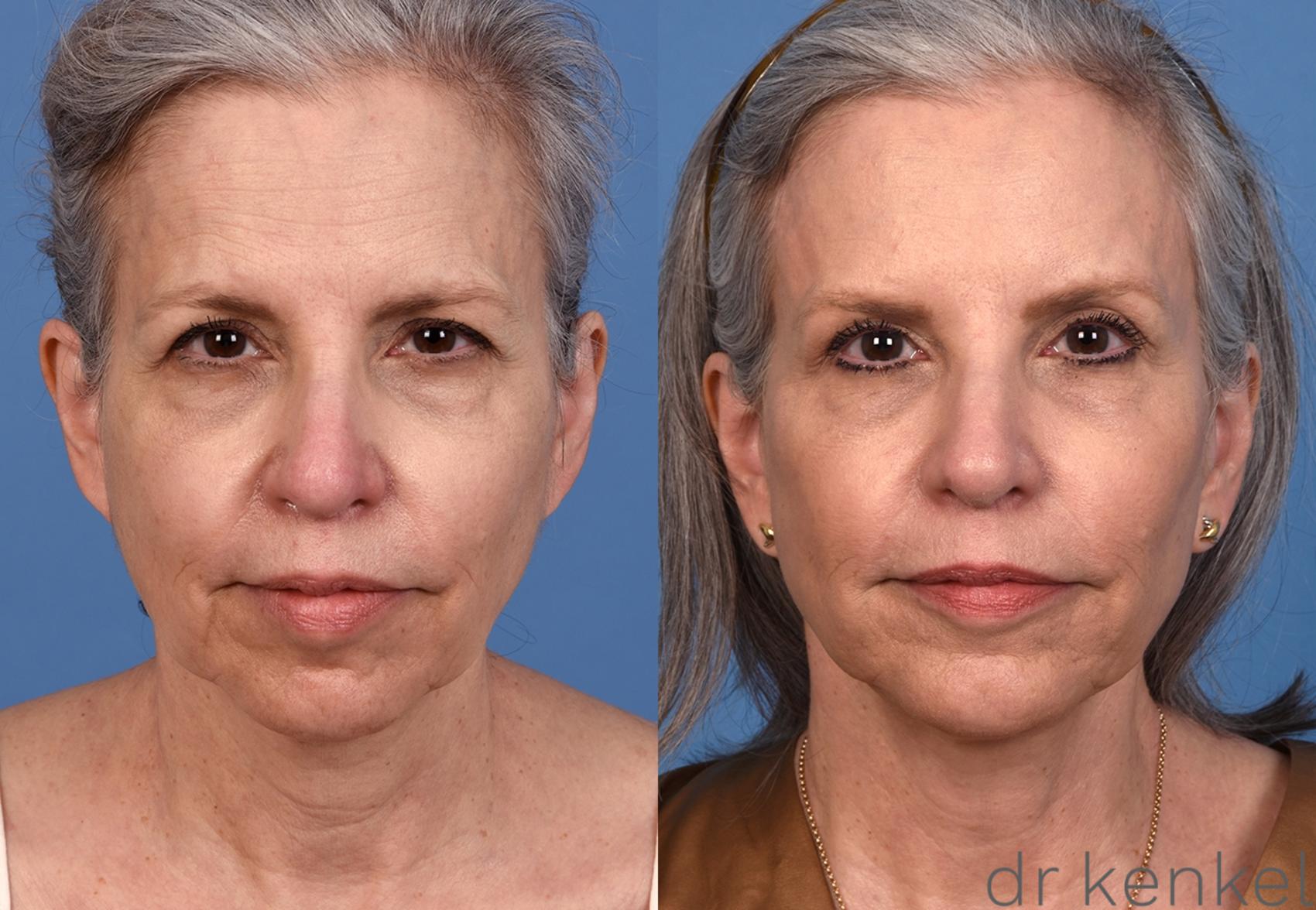 Before & After Facelift Case 357 Front View in Dallas, Frisco, McKinney, Prosper, Allen, Celina, Denton, Anna, TX