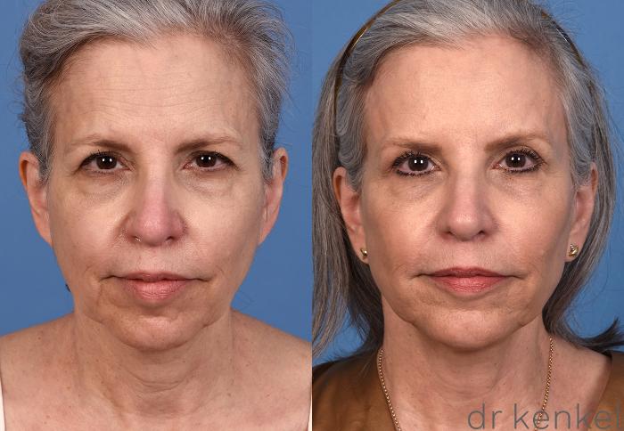 Before & After Facelift Case 357 Front View in Dallas, Frisco, McKinney, Prosper, Allen, Celina, Denton, Anna, TX