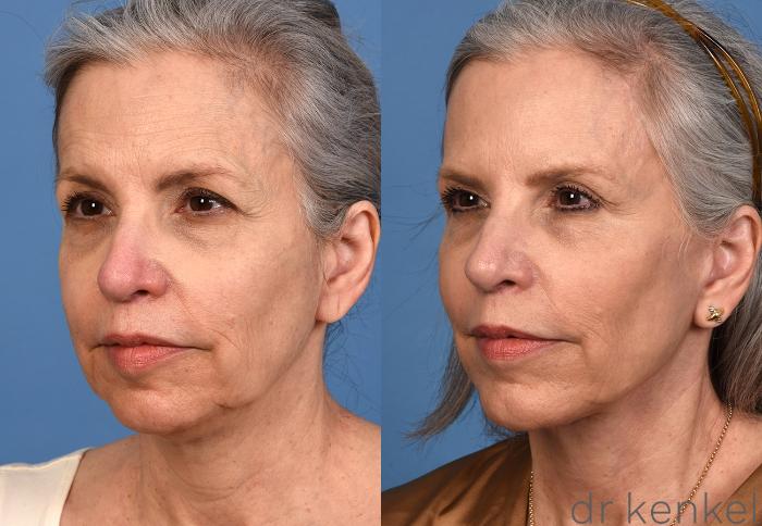 Before & After Facelift Case 357 Left Oblique View in Dallas, Frisco, McKinney, Prosper, Allen, Celina, Denton, Anna, TX