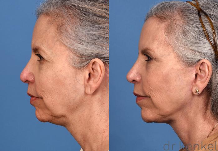 Before & After Facelift Case 357 Left Side View in Dallas, Frisco, McKinney, Prosper, Allen, Celina, Denton, Anna, TX