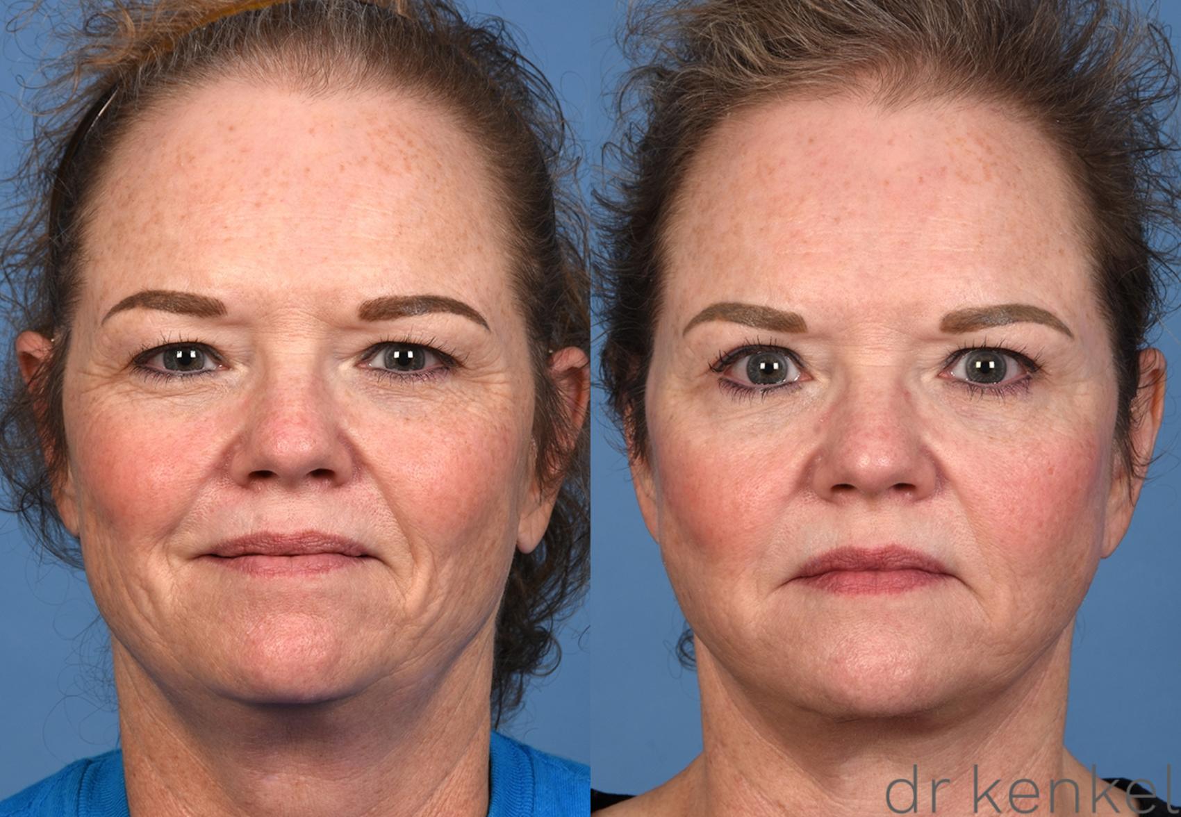 Before & After Brow Lift Case 363 Front View in Dallas, Frisco, McKinney, Prosper, Allen, Celina, Denton, Anna, TX