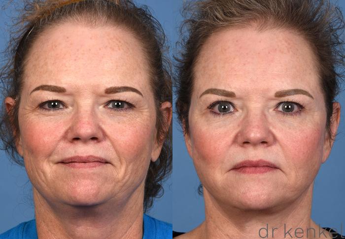 Before & After Brow Lift Case 363 Front View in Dallas, Frisco, McKinney, Prosper, Allen, Celina, Denton, Anna, TX