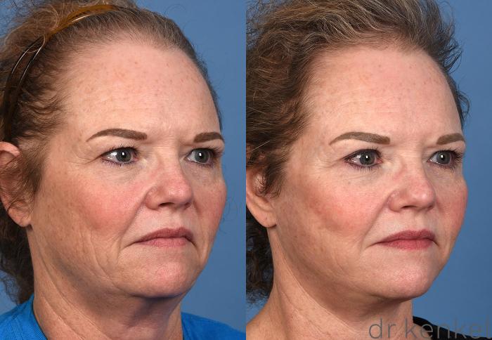 Before & After Brow Lift Case 363 Right Oblique View in Dallas, Frisco, McKinney, Prosper, Allen, Celina, Denton, Anna, TX