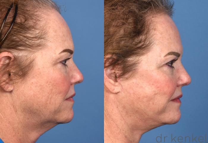 Before & After Brow Lift Case 363 Right Side View in Dallas, Frisco, McKinney, Prosper, Allen, Celina, Denton, Anna, TX
