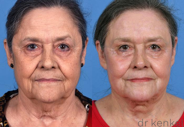 Before & After Brow Lift Case 373 Front View in Dallas, Frisco, McKinney, Prosper, Allen, Celina, Denton, Anna, TX