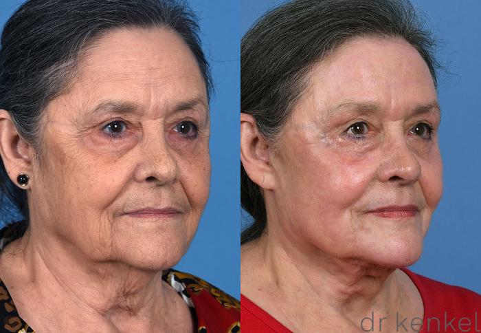 Before & After Brow Lift Case 373 Right Oblique View in Dallas, Frisco, McKinney, Prosper, Allen, Celina, Denton, Anna, TX
