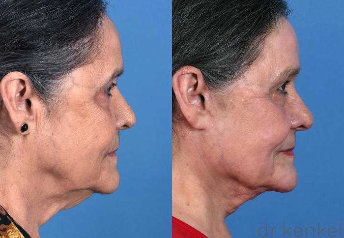 Before & After Brow Lift Case 373 Right Side View in Dallas, Frisco, McKinney, Prosper, Allen, Celina, Denton, Anna, TX