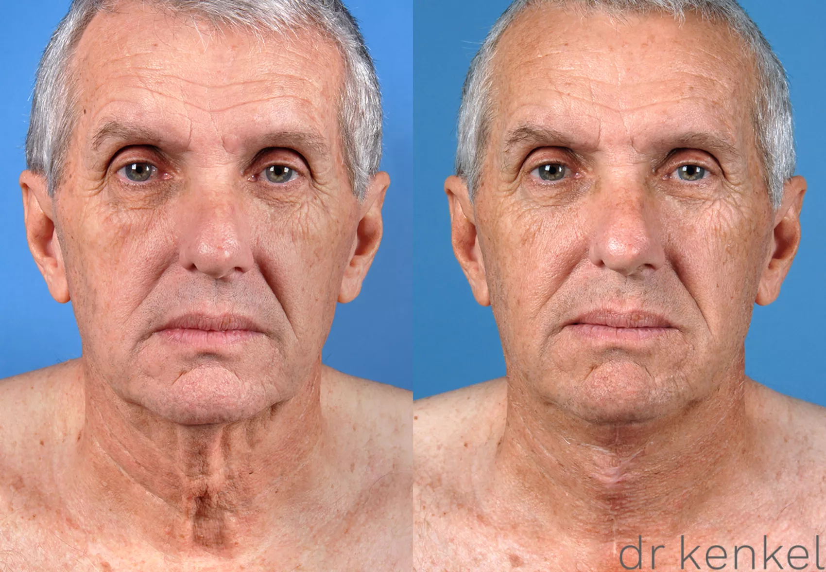 direct-neck-excision-169-view-