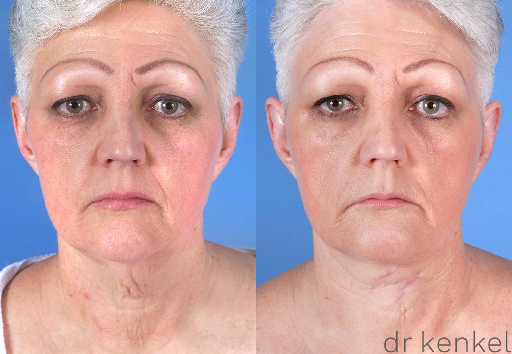 Before & After Direct Neck Excision Case 170 View #1 View in Dallas, TX