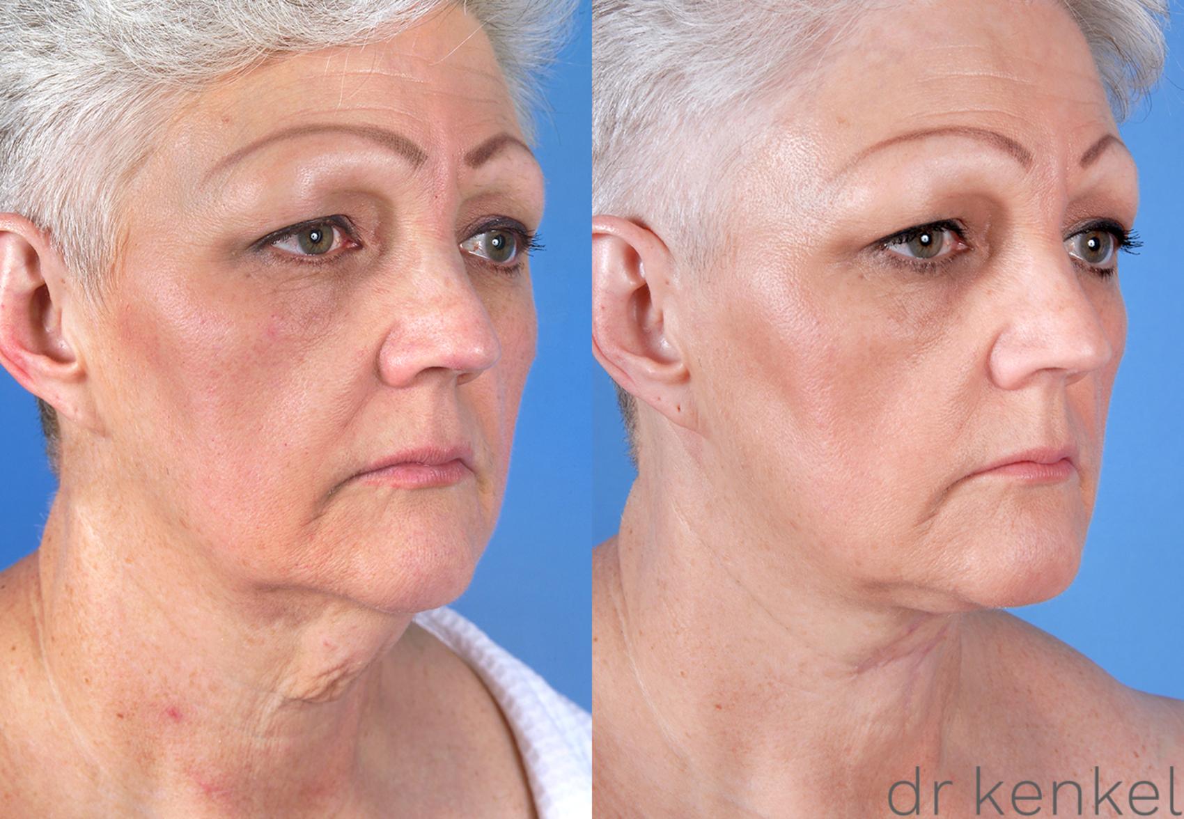 Before & After Direct Neck Excision Case 170 View #2 View in Dallas, TX