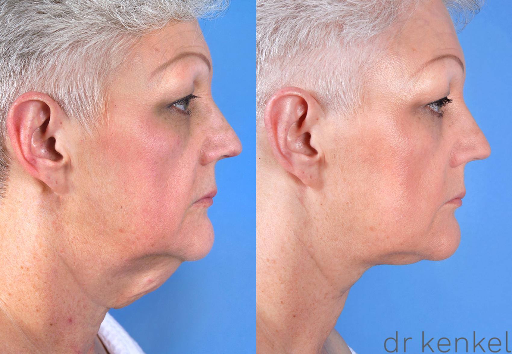 Before & After Direct Neck Excision Case 170 View #3 View in Dallas, TX
