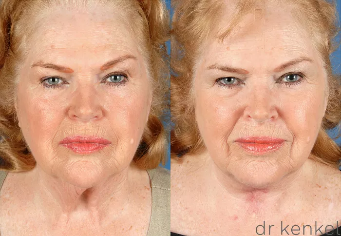 【裁断済み】外傷形成外科 Emergency Plastic Surgery direct-neck-excision-222-view-