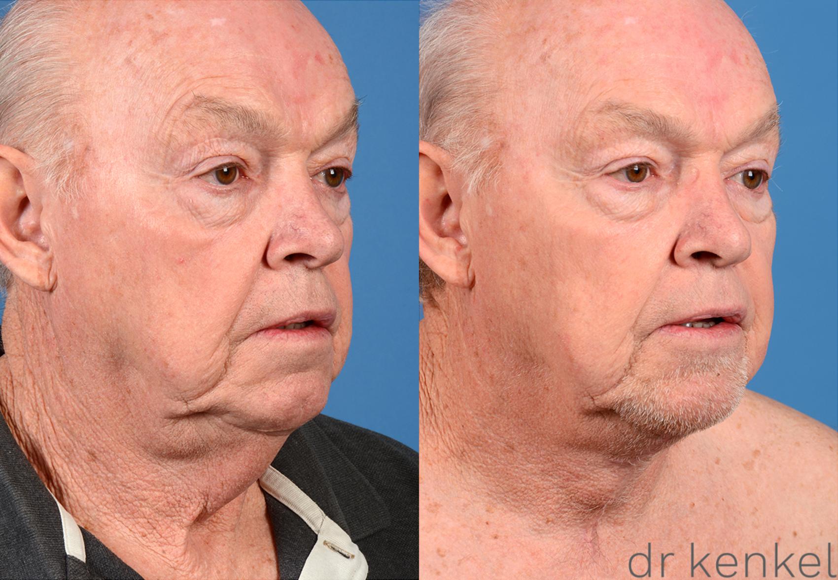 Before & After Direct Neck Excision Case 224 View #2 View in Dallas, TX