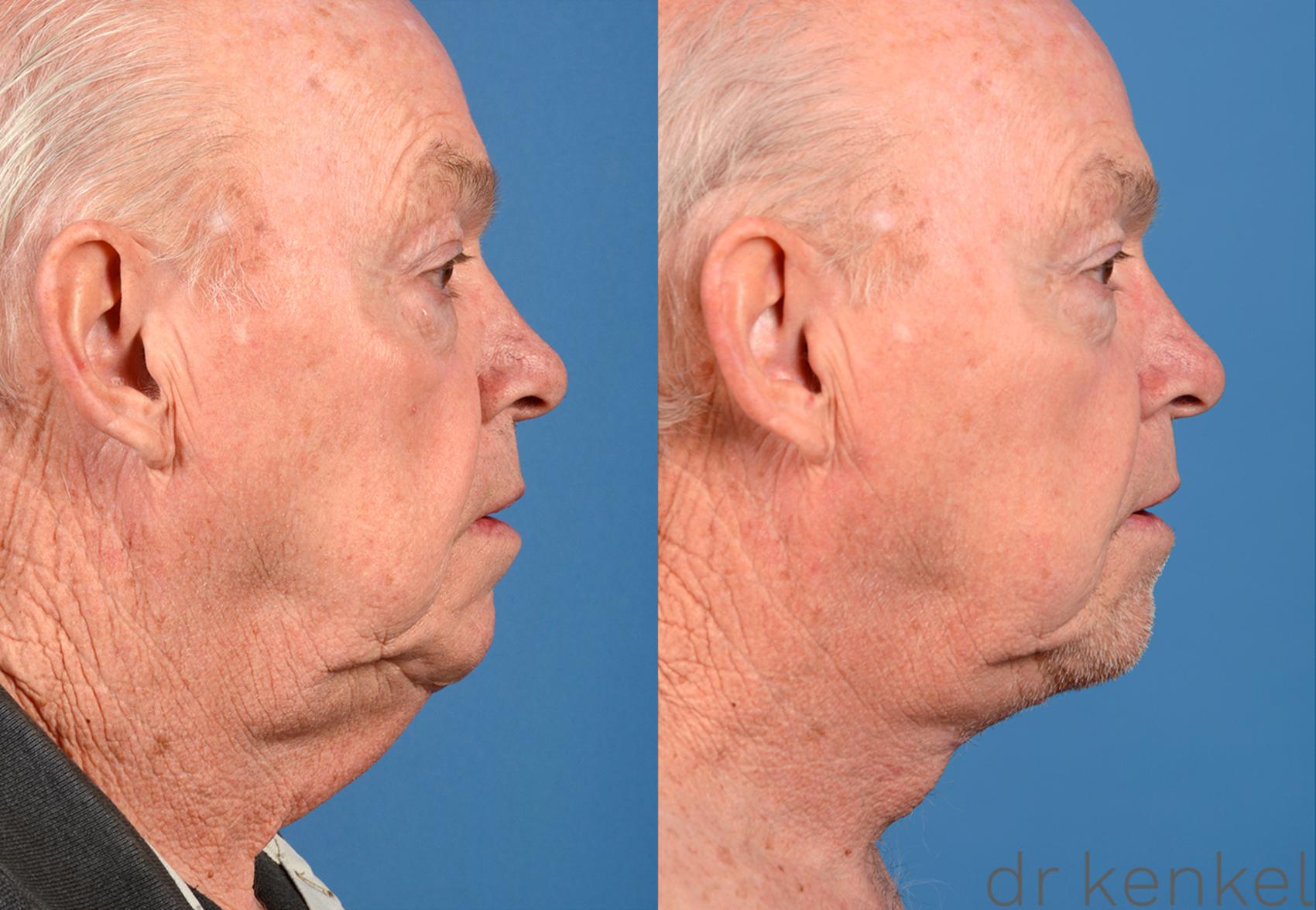 Before & After Direct Neck Excision Case 224 View #3 View in Dallas, TX