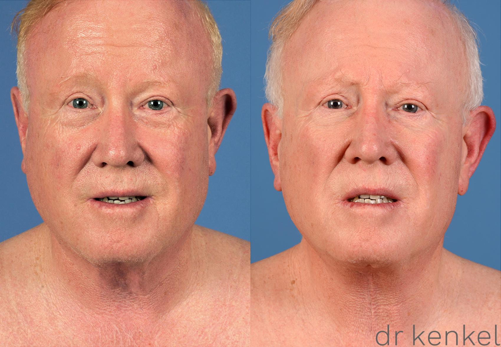 Before & After Direct Neck Excision Case 225 View #1 View in Dallas, TX