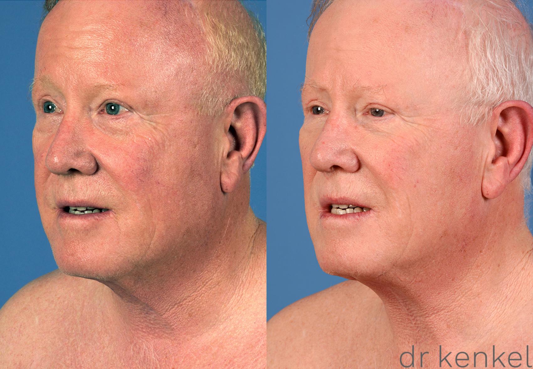 Before & After Direct Neck Excision Case 225 View #2 View in Dallas, TX
