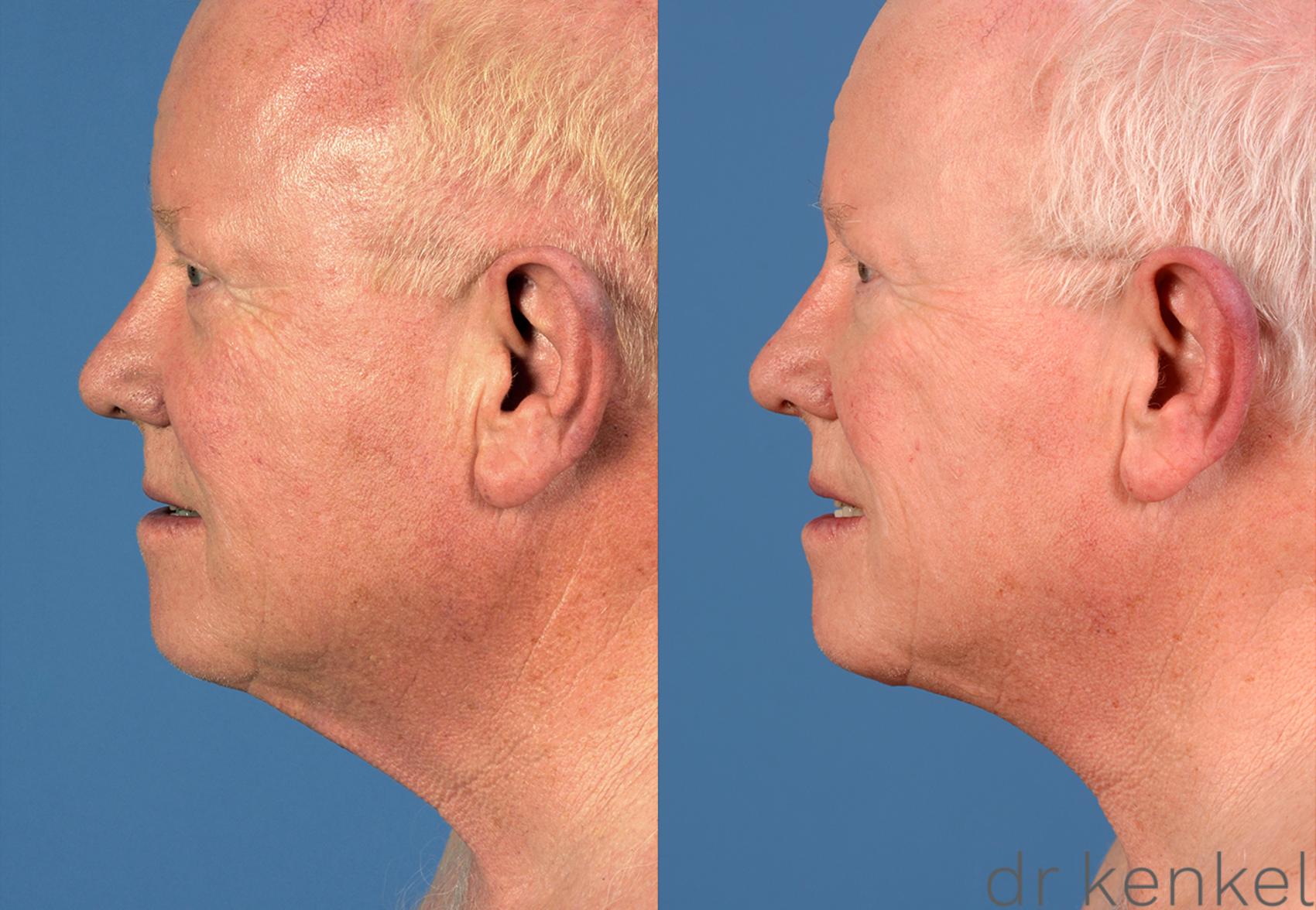 Before & After Neck Lift Case 225 View #3 View in Dallas, TX