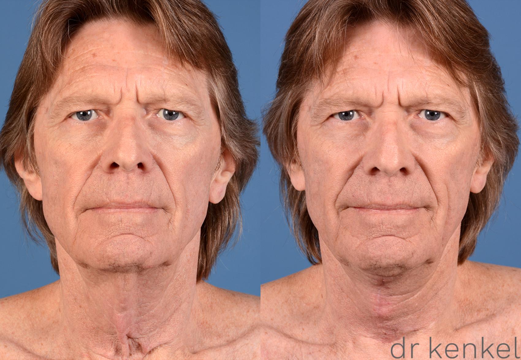 Before & After Direct Neck Excision Case 227 View #1 View in Dallas, TX