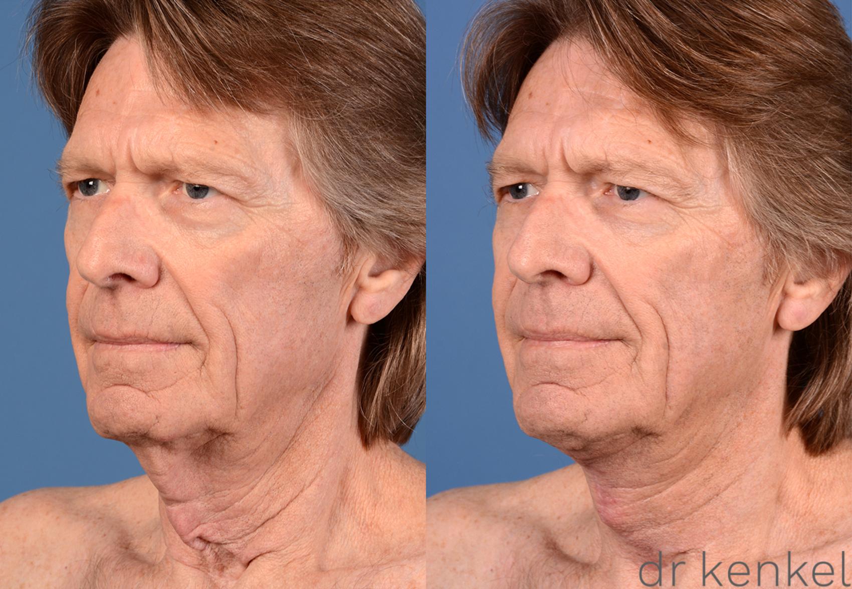 Before & After Direct Neck Excision Case 227 View #2 View in Dallas, TX