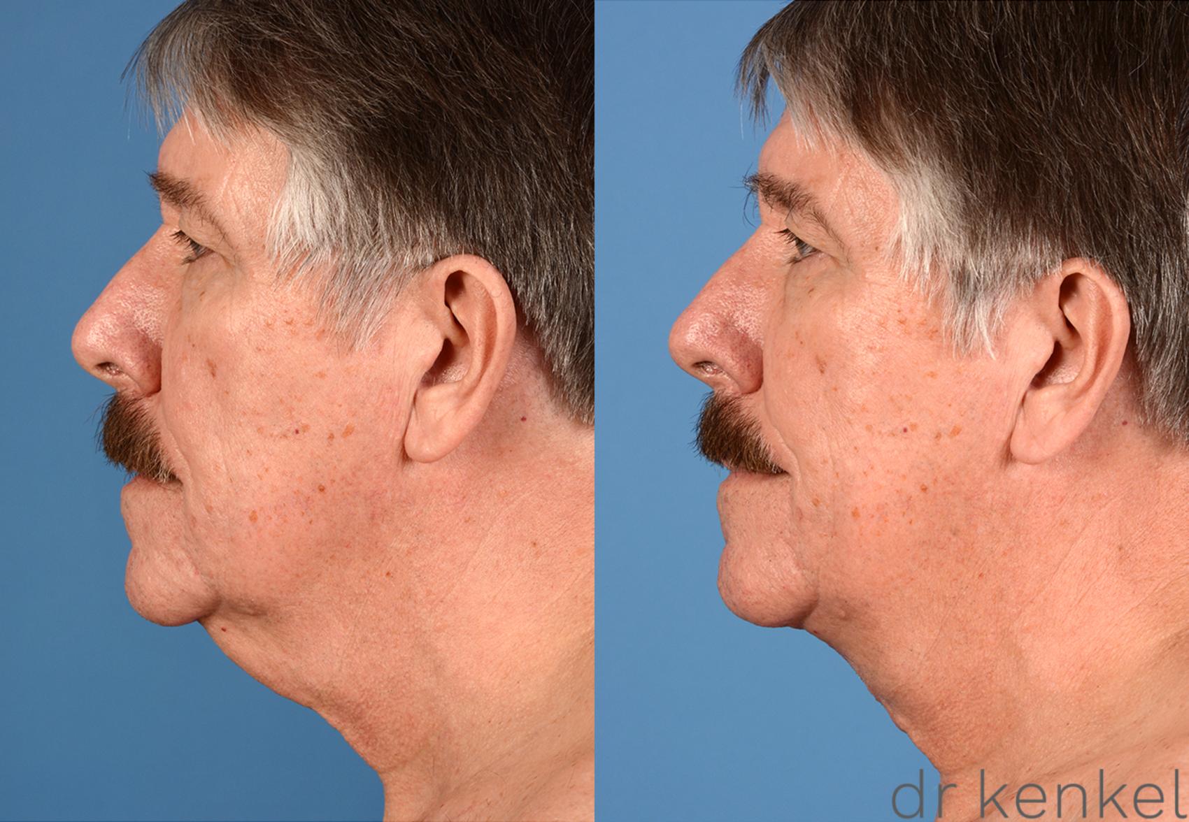 Before & After Neck Lift Case 228 View #3 View in Dallas, TX