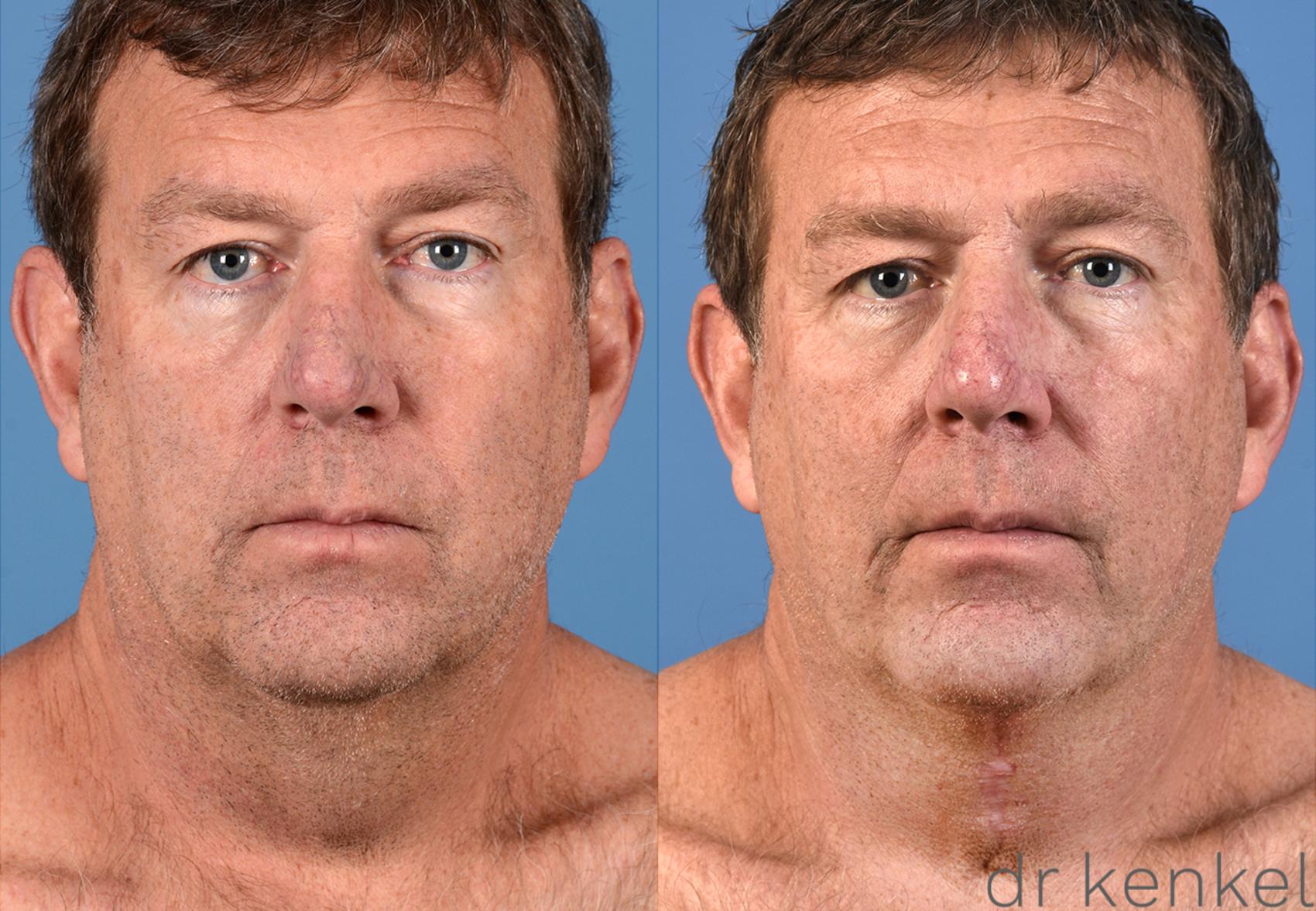 Before & After Direct Neck Excision Case 305 View #1 View in Dallas, TX