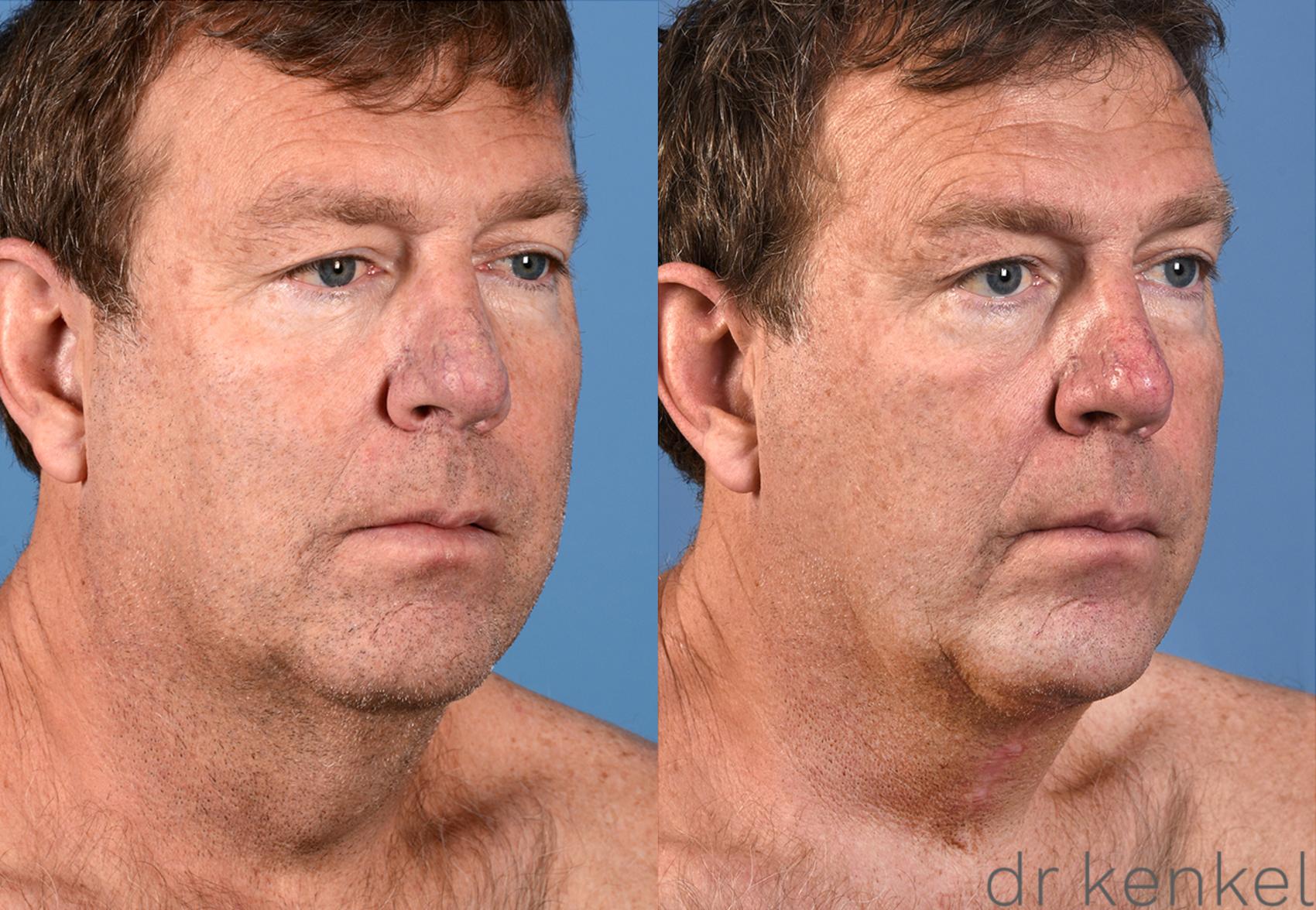 Before & After Direct Neck Excision Case 305 View #2 View in Dallas, TX