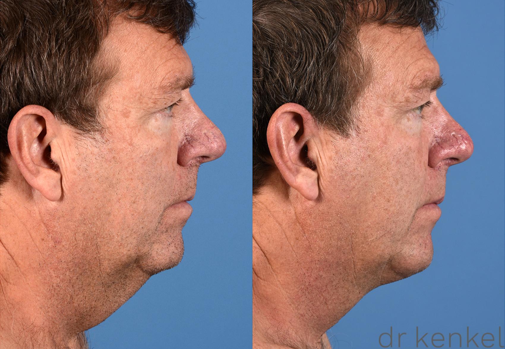 Before & After Direct Neck Excision Case 305 View #3 View in Dallas, TX