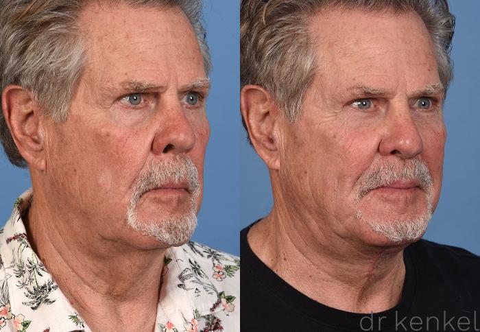 Before & After Direct Neck Excision Case 353 Right Oblique View in Dallas, Frisco, McKinney, Prosper, Allen, Celina, Denton, Anna, TX