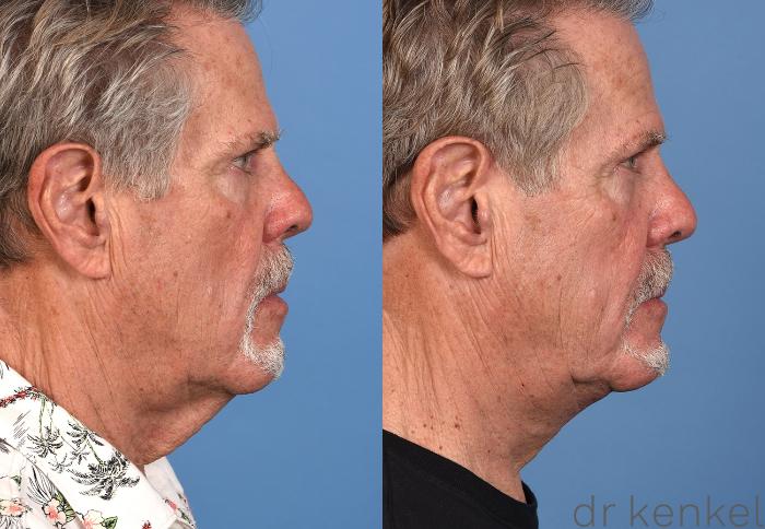 Before & After Direct Neck Excision Case 353 Right Side View in Dallas, Frisco, McKinney, Prosper, Allen, Celina, Denton, Anna, TX