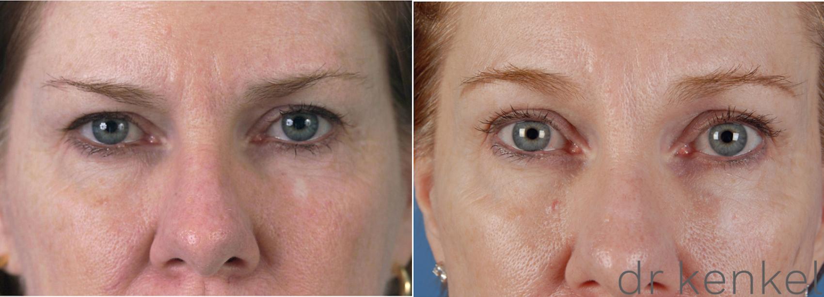 Before & After Eyelid Surgery Case 28 View #1 View in Dallas, TX