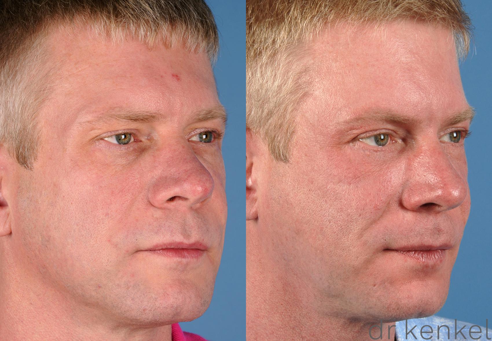 Before & After Eyelid Surgery Case 284 View #2 View in Dallas, TX