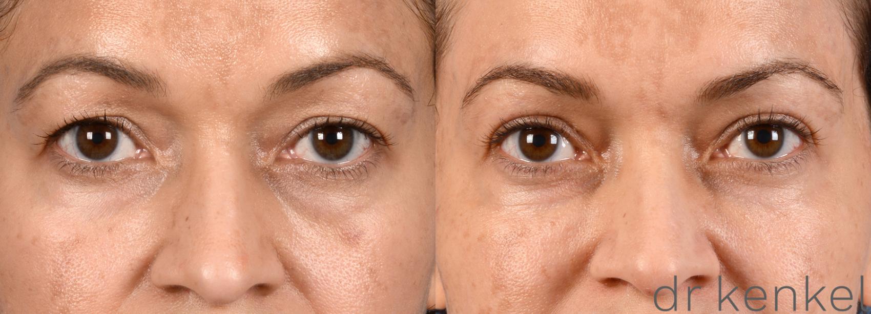 Before & After Eyelid Surgery Case 286 View #1 View in Dallas, TX