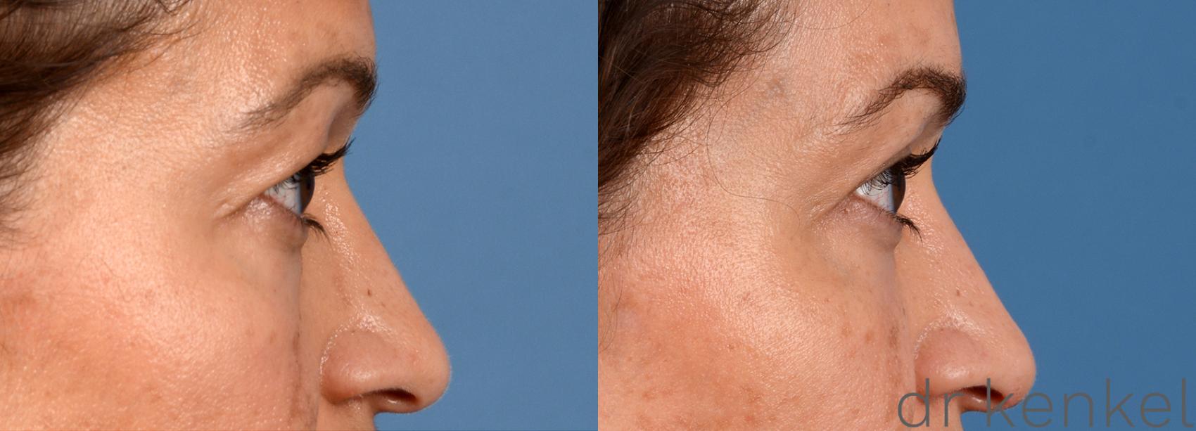 Before & After Eyelid Surgery Case 286 View #2 View in Dallas, TX
